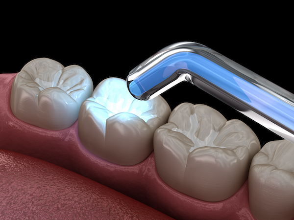 composite-restoration