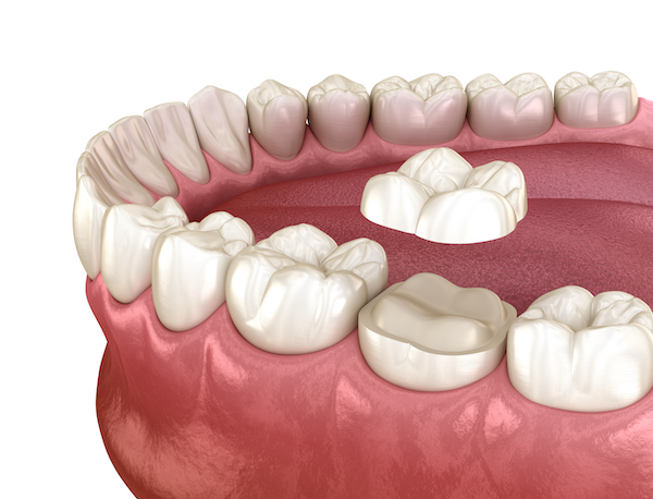 dental-onlay