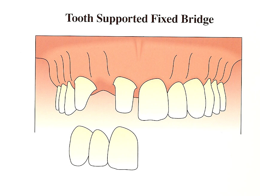 fixed-bridge