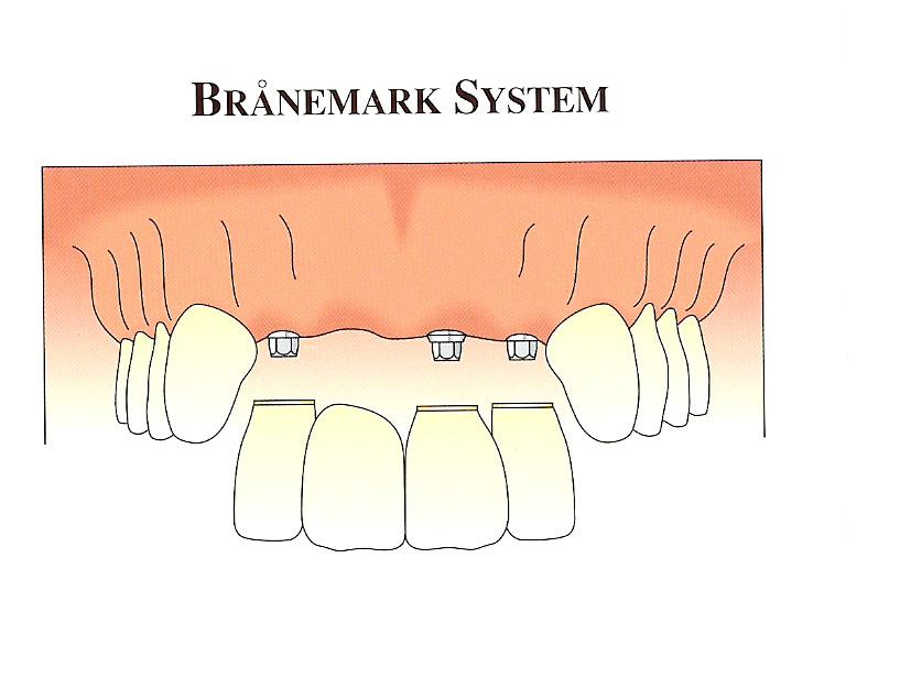 implant-supported-bridge