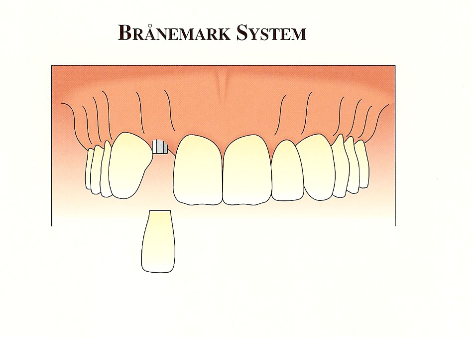 implant-supported-crown