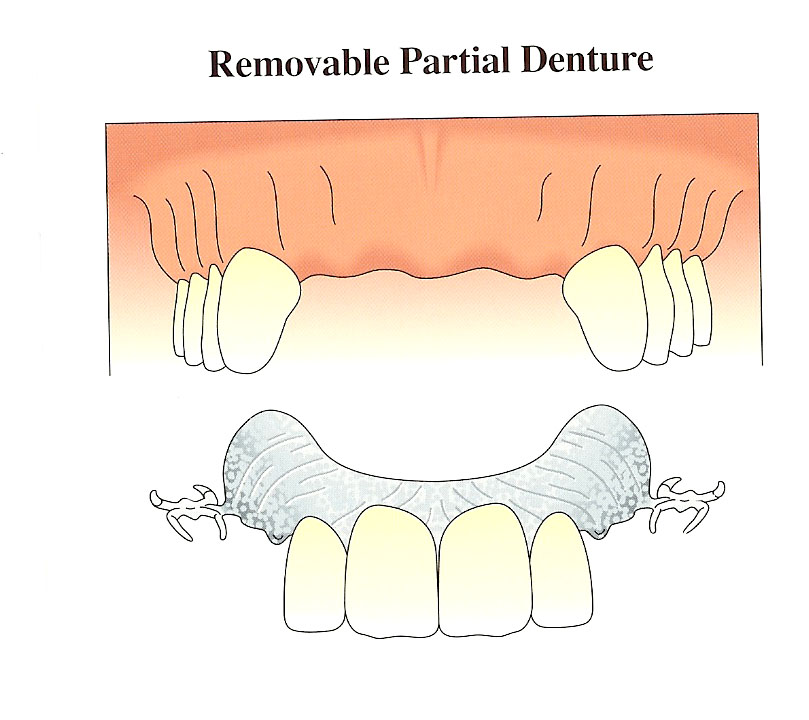 removable-partial-denture